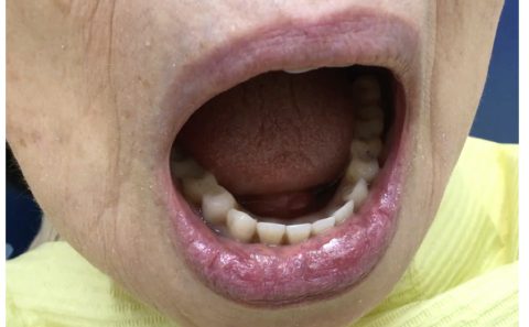 入れ歯の診査で見るべきポイント、お口の中