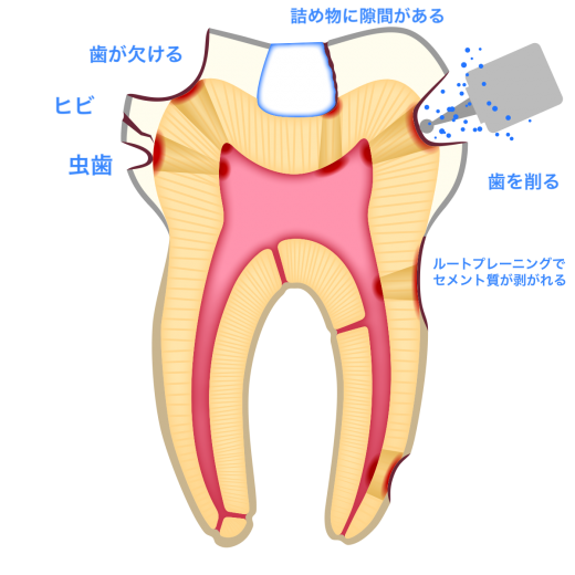象牙細管を通し、歯髄炎が起こる原因